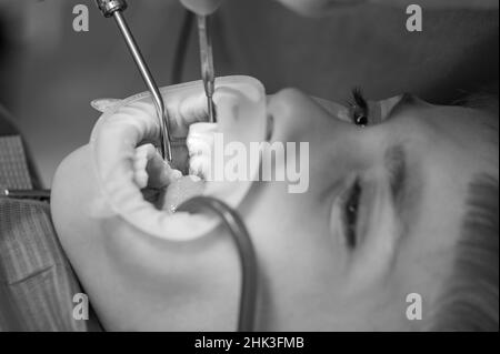 Le dentiste nettoie la carie dentaire d'un enfant avec une perceuse, dans la bouche d'un enfant éjecteur de salive, traitement dentaire de près, enrouleur dentaire sur les lèvres de Banque D'Images