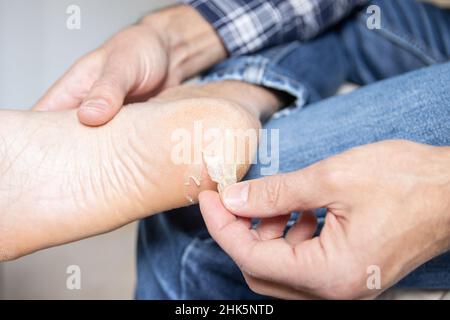 Peau de boursouflure cassée et sèche sur le pied Banque D'Images