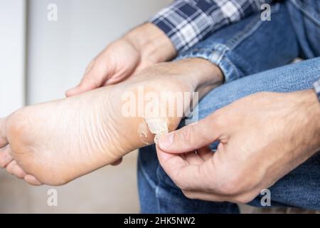 Peau de boursouflure cassée et sèche sur le pied Banque D'Images