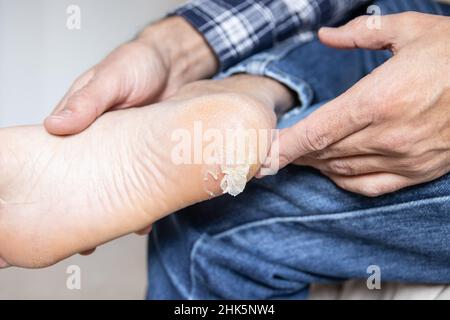 Peau de boursouflure cassée et sèche sur le pied Banque D'Images