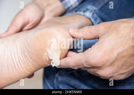 Peau de boursouflure cassée et sèche sur le pied Banque D'Images