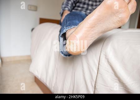 Peau de boursouflure cassée et sèche sur le pied Banque D'Images