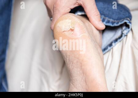 Peau de boursouflure cassée et sèche sur le pied Banque D'Images