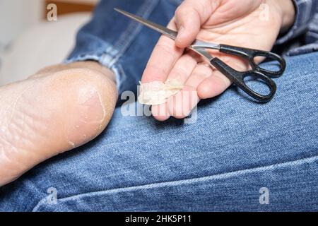 Peau de boursouflure cassée et sèche sur le pied Banque D'Images