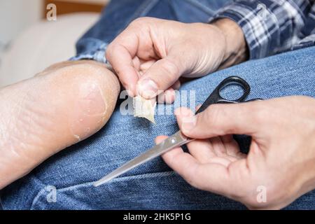 Peau de boursouflure cassée et sèche sur le pied Banque D'Images