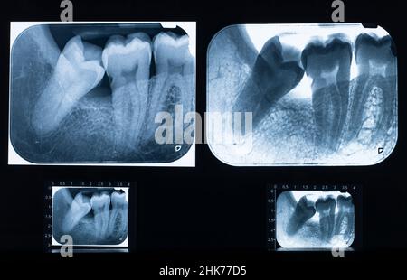 Examen détaillé des rayons X avec problème de dents de sagesse impactées Banque D'Images