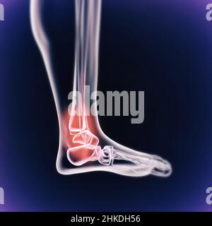 Quand l'inflammation frappe.Vue cgi d'un joint enflammé isolé en bleu. Banque D'Images