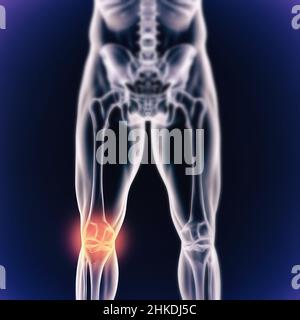 Quand l'inflammation frappe.Vue cgi d'un joint enflammé isolé en bleu. Banque D'Images