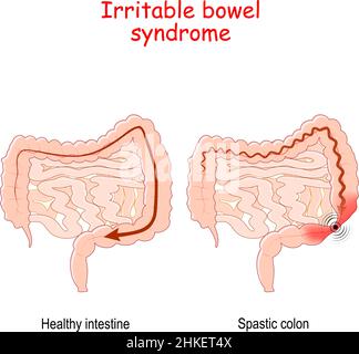 Le syndrome du côlon irritable est un trouble gastro-intestinal fonctionnel.Illustration vectorielle Illustration de Vecteur