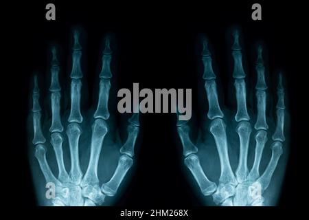 image radiographique des mains humaines gauche et droite Banque D'Images