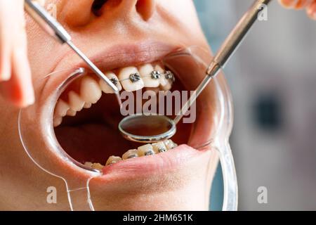 Une jeune femme avec des bretelles métalliques est examinée par un orthodontiste.Correction de la morsure des dents dans la clinique dentaire.Concept de dents saines. Banque D'Images