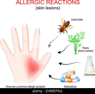 réaction allergique et lésions cutanées. La main humaine avec une éruption cutanée ou une urticaire. Allergènes qui ont causé une allergie: Médicaments, produits chimiques, contact direct Illustration de Vecteur