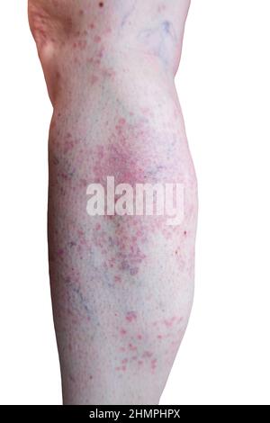 Détail d'un Granuloma annulare généralisé, une maladie rare de la peau, sur une jambe d'une patiente Banque D'Images