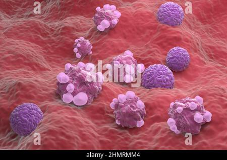 Cellules cancéreuses ovariennes - illustration de la vue isométrique 3D Banque D'Images