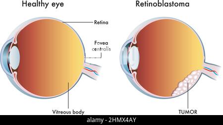 L'illustration médicale compare un œil sain à un œil affecté par le rétinoblastome. Illustration de Vecteur