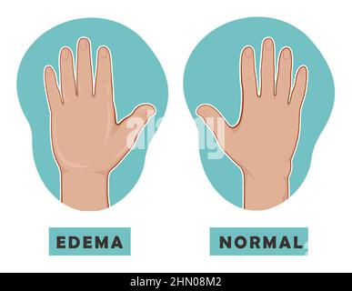 Main gonflée et main normale. Œdème et lymphoedème. Illustration vectorielle de la maladie avant-après. Illustration de Vecteur