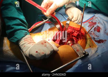 Chirurgie de remplacement du genou dans le bloc opératoire Banque D'Images