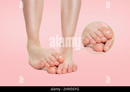 Les pieds femelles sont placés l'un sur l'autre, avec la maladie de champignon d'ongle. Agrandissement de l'image des ongles les plus hachés. Fond rose. Concept de dermatologique di Banque D'Images