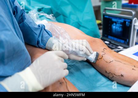 Processus de chirurgie de la veine variqueuse dans l'hôpital, salle d'opération, scellement de la veine, chirurgie vasculaire veineuse concept Banque D'Images