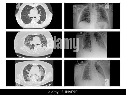 Résultats des radiographies des patients atteints de la tomographie COVID-19 pneumonia.Computed du thorax , scanner du thorax dans un cas confirmé de la tomographie COVID-19 Banque D'Images