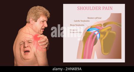 Le collage d'un homme âgé avec une douleur d'épaule sur fond noir.Concept de soins de santé Banque D'Images