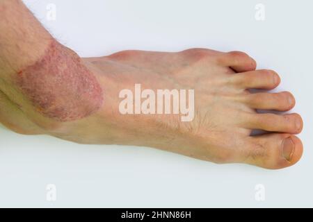 Le pied souffre de dermatite dans la phase aiguë de l'allergie et du psoriasis. Le concept de traitement et de prévention des maladies de la peau Banque D'Images