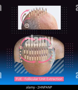Méthodes de la transplantation de cheveux fut vs Fue avec éléments d'infographie de l'illustration. Banque D'Images