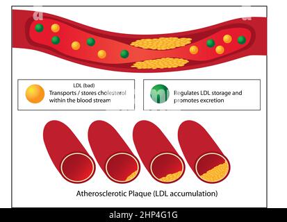 Rôle des bons et mauvais lipides et niveaux de plaque athérosclérotique de vaisseau sanguin vecteur médicale infographie Banque D'Images