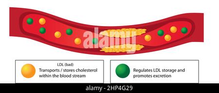 Plaque athérosclérotique de vaisseau sanguin et de bons et mauvais lipides vector infographie Banque D'Images