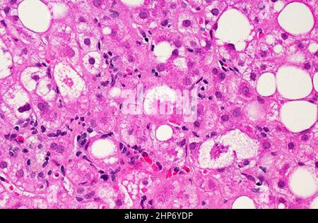 Image microscopique du tissu hépatique affecté par une stéatose hépatique non alcoolique (NAFLD). Les gros et petits points blancs sont des gouttelettes de graisse en excès remplissant les cellules du foie (hépatocytes) ca. 2019 Banque D'Images