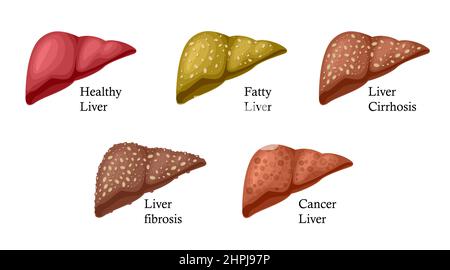 Stades de lésions hépatiques. Maladie du foie. Cancer sain, gras, fibrose hépatique et cirrhose. Illustration isolée sur fond blanc. Illustration de Vecteur