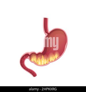 Illustration médicale réaliste de la pyrose estomac isolé. Trouble du feu à l'intérieur de l'estomac. Illustration de Vecteur