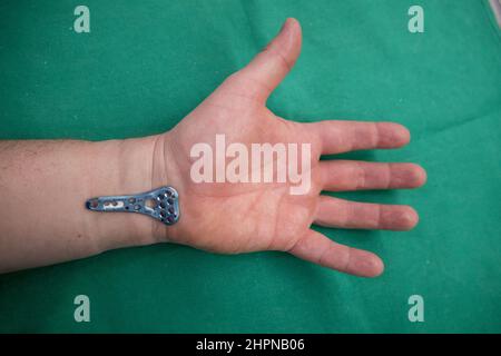 une plaque de rayon en titane bleu explanté se trouve sur le poignet ...