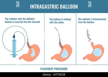 Ballon gastrique, illustration conceptuelle Banque D'Images