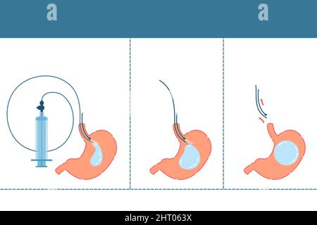 Ballon gastrique, illustration conceptuelle Banque D'Images