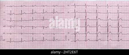 Électrocardiogramme gros plan sur papier, cardiologie et soins de santé Banque D'Images