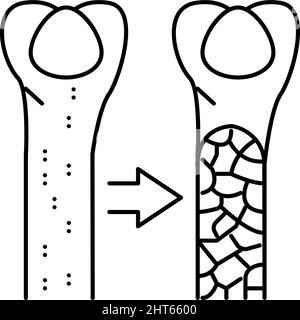 illustration du vecteur de l'icône de la ligne de la maladie osseuse de l'ostéoporose Illustration de Vecteur