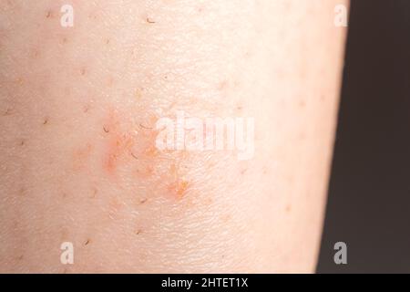 Streptoderma - dermatite sur la peau humaine, tache ronde rouge, macrophotographie, inflammation bactérienne Banque D'Images