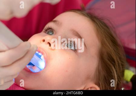 Ultraviolet en dentisterie, le dentiste tient un dispositif à la lumière ultraviolette pour sceller rapidement le remplissage dans la dent de l'enfant, la fille garde sa bouche Banque D'Images