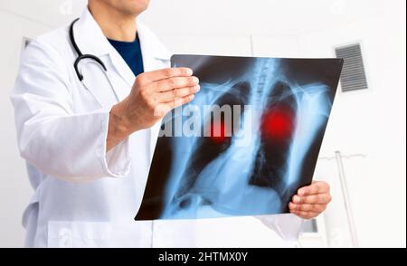 Cancer du poumon ou pneumonie. Examen par le médecin de l'image radiologique ont un problème de tumeur pulmonaire du patient ou de longue cavid à l'hôpital Banque D'Images