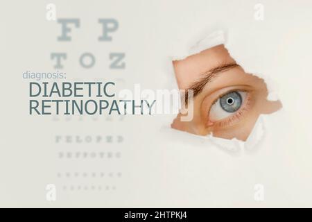 Affiche sur la maladie de la rétinopathie diabétique avec graphique de test oculaire et œil bleu.fond gris studio Banque D'Images