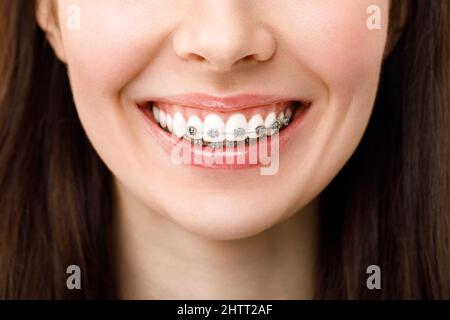 Traitement orthodontique. Concept de soins dentaires. Belle femme en bonne santé sourire gros plan. Gros plan sur les supports en céramique et en métal des dents. Magnifique sourire. Banque D'Images