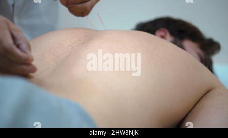 Acupuncture.Gros plan du dos de l'homme avec les aiguilles coincées.Médecine chinoise avec acupuncture.L'homme récupère la santé au masseur professionnel sur le chinois M. Banque D'Images