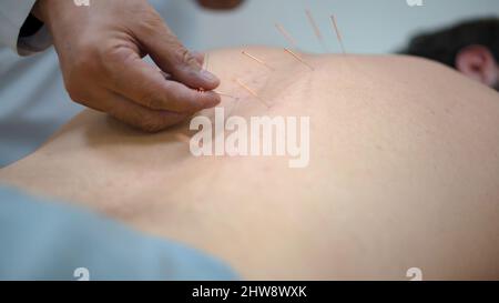 Acupuncture.Gros plan du dos de l'homme avec les aiguilles coincées.Médecine chinoise avec acupuncture.L'homme récupère la santé au masseur professionnel sur le chinois M. Banque D'Images