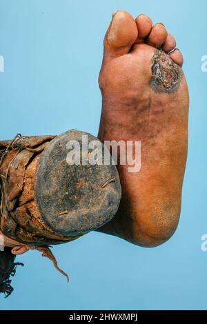 Mycétome sur la semelle du pied droit d'un patient. Mycétome est une maladie rare trouvée dans les tropiques. Il s'agit d'une infection chronique localisée de TH Banque D'Images