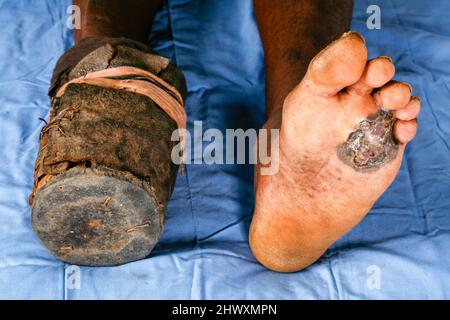 Mycétome sur la semelle du pied droit d'un patient. Mycétome est une maladie rare trouvée dans les tropiques. Il s'agit d'une infection chronique localisée de TH Banque D'Images