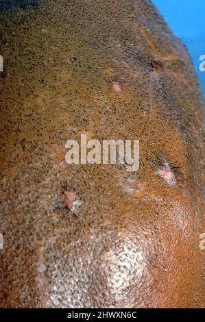 Actinomycetome sur la tête d'un homme de 36 ans. Mycétome est une maladie rare trouvée dans les tropiques. Il s'agit d'une infection chronique localisée des s Banque D'Images