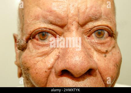 Un homme a un papillome de peau, une croissance bénigne de type mamelon à la surface de la peau ou de la muqueuse. (MODÈLE DISPONIBLE) Banque D'Images