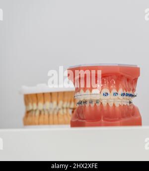 Entretoises en métal et en céramique sur les dents sur une mâchoire artificielle de près. Accolades sur les dents artificielles gros plan, dentisterie dentaire. Modèle de mâchoire pour l'affichage d'un Banque D'Images