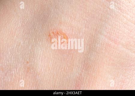 Streptoderma - dermatite sur la peau humaine, tache ronde rouge, macrophotographie, inflammation bactérienne Banque D'Images